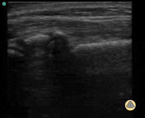 Peds-MSK - Salter Harris II Fracture
