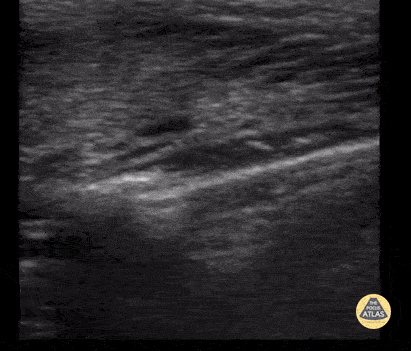Peds-MSK - Clavicle Fracture