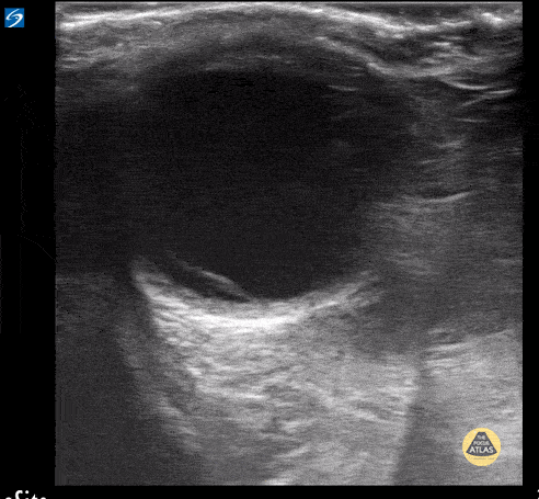 Peds-Orbital - Retinal Detachment