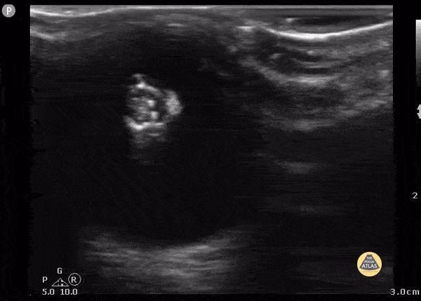Peds-Orbital - Lens Calcification