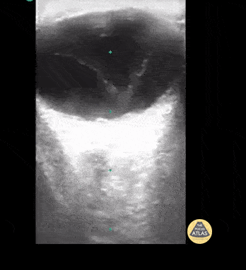 Peds-Orbital - Vitreous Detachment
