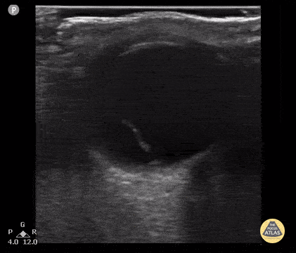 Peds-Orbital - Retinal Detachment 4
