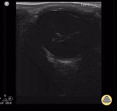Peds-Orbital - Proliferative Vitreoretinopathy 1 of 2