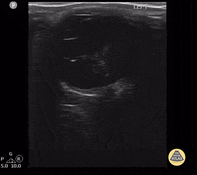 Peds-Orbital - Proliferative Vitreoretinopathy 2 of 2