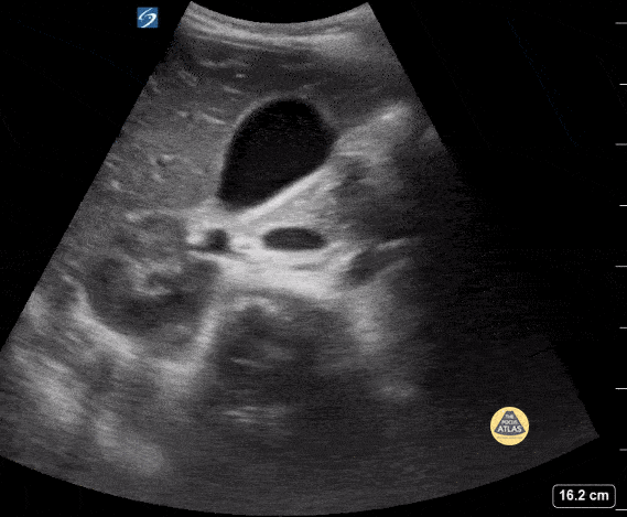 Peds-Biliary - Normal Gallbladder, Short Axis