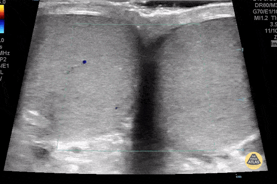 Peds-Genitourinary - Testicles Buddy View