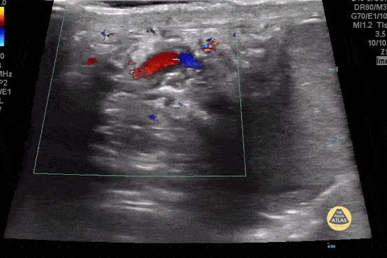 Peds-Genitourinary - Normal Spermatic Cord