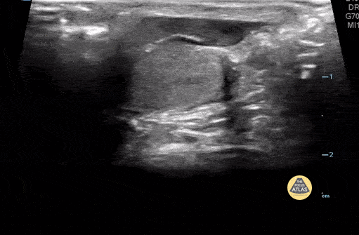 Peds-Genitourinary - Torsion of the Appendix Testicle