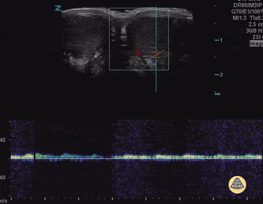 Peds-Genitourinary - Spermatic Cord "Corkscrew"