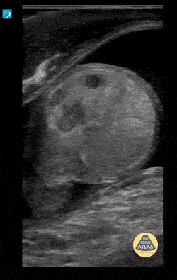Peds-Genitourinary - Prolonged Testicular Torsion