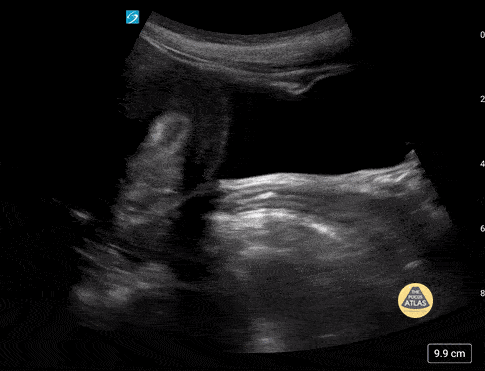 Peds-Genitourinary - Normal Adolescent Uterus