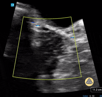 Peds-Genitourinary - Normal Ovary