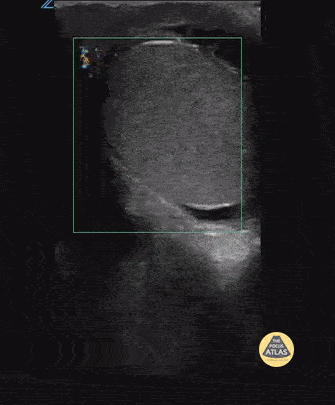 Peds-Genitourinary - Testicular Torsion Case Series 1 of 2