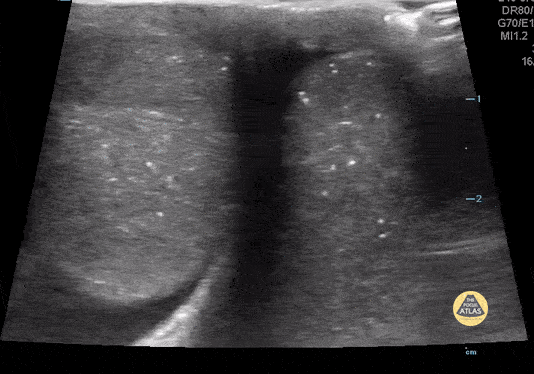 Peds-Genitourinary - Testicular Torsion Case Series 2 of 2
