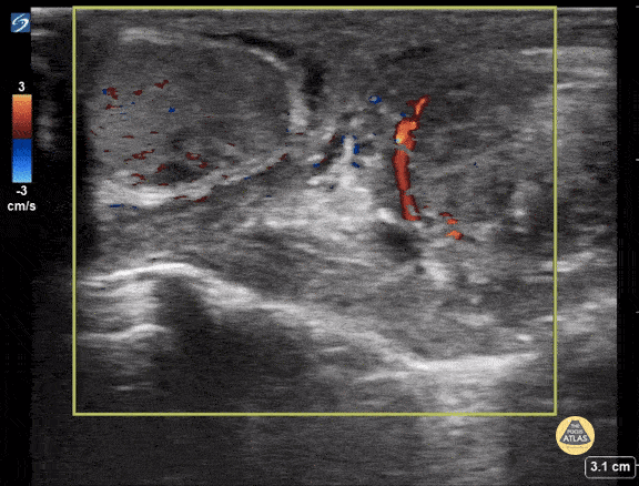 Peds-Genitourinary - Left Sided Testicular Torsion
