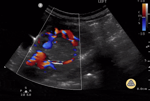 Peds-Genitourinary - Wilm's Tumor Case Series 2 of 2