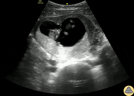 OB/Gyn - Twin Gestation