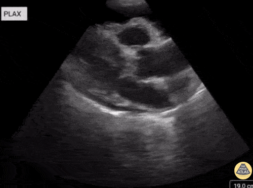 UPLOADS FOR REVIEW - Cardiac Tamponade