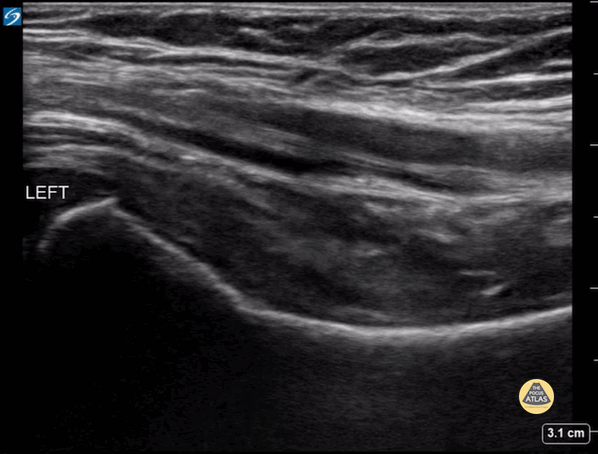 Peds-MSK - Normal Hip Joint