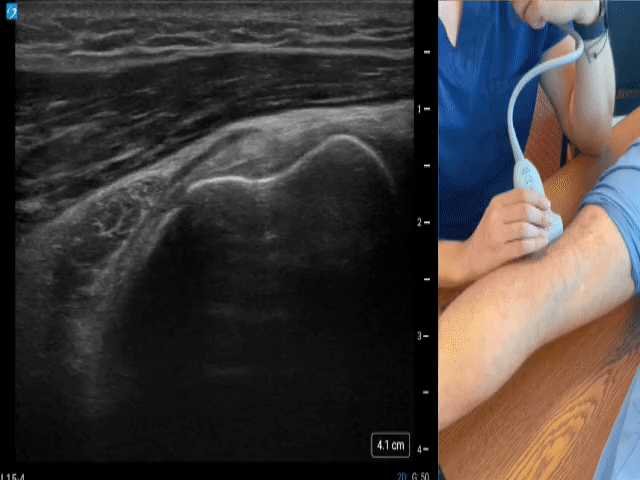 Knee Gallery - Suprapatellar/quad tendon (Short axis)