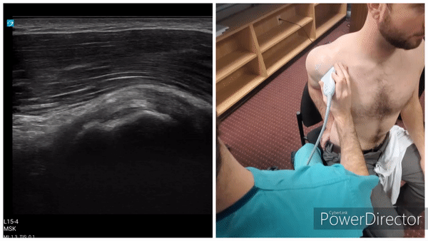 Shoulder Gallery - Supraspinatus (Short Axis)