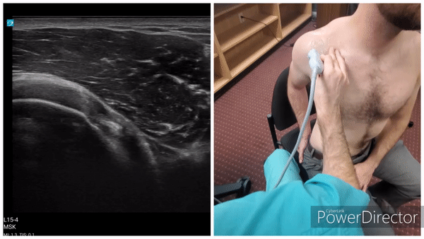 Shoulder Gallery - Supraspinatus (Long Axis)