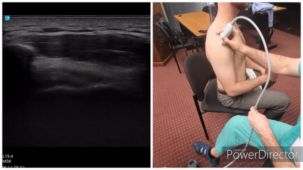 Shoulder Gallery - Supraspinatus (Neutral)