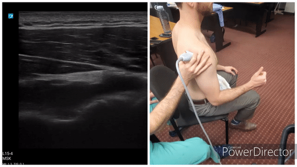 Shoulder Gallery - Infraspinatus (Long Axis)