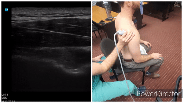 Shoulder Gallery - Infraspinatus/Teres Minor (Long Axis)