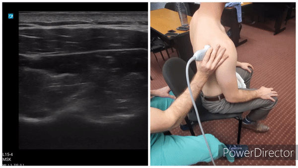 Shoulder Gallery - Infraspinatus / Teres Minor (Short Axis)