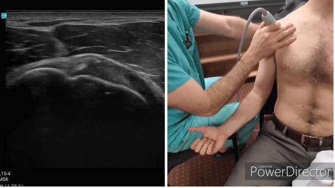 Shoulder Gallery - Biceps Tendon/Bicipital Groove (short axis)