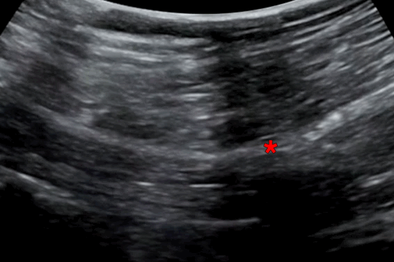 Nerve Block Atlas Home - Transgluteal Sciatic