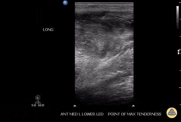Musculoskeletal - Soleus Hematoma