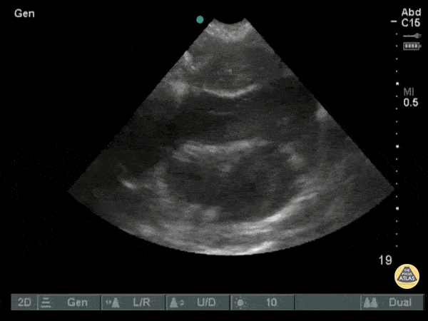 Pericardial Disease - Hemopericardium From a Stab Wound