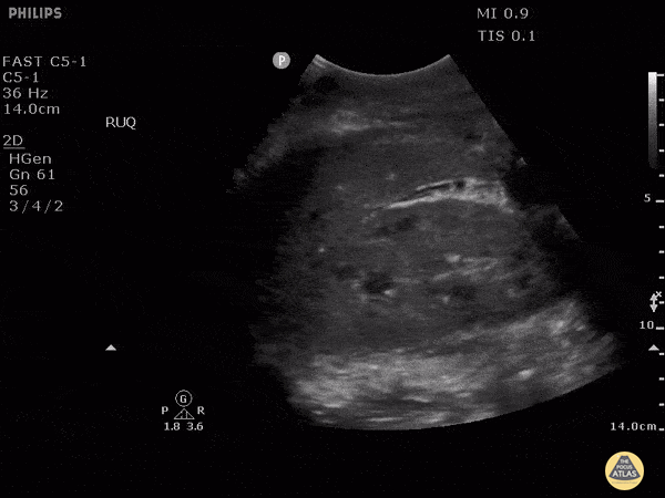 Trauma - Hemoperotineum Or Not?