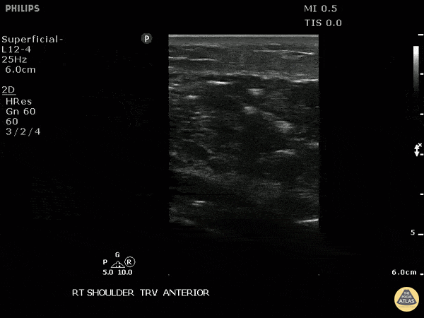 Soft Tissue - Necrotizing Soft Tissue Infection Of The Shoulder