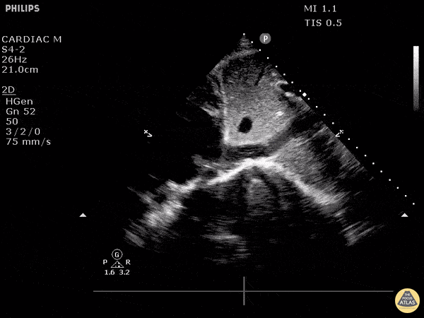 IVC & Abnormal Venous Waveforms - Clot At Junction of Right Atrium and IVC