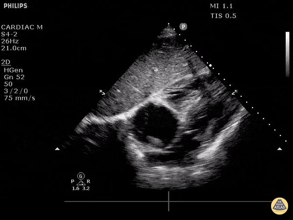Other Cardiac Pathology - Clot Within Right Atrium