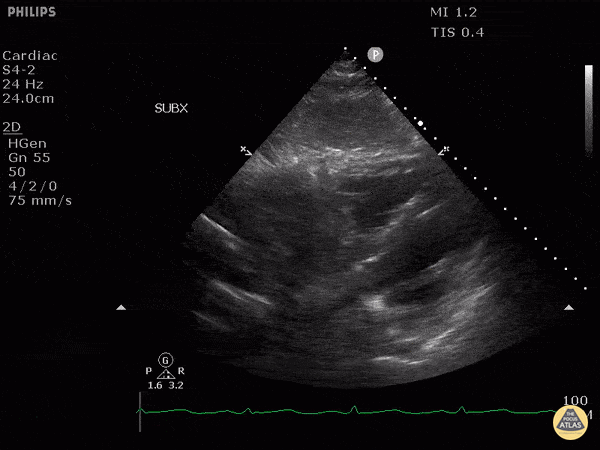 Cardiac Tumors - Cardiac Sarcoma