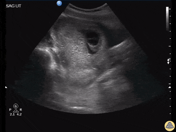 OB/Gyn - Molar Pregnancy