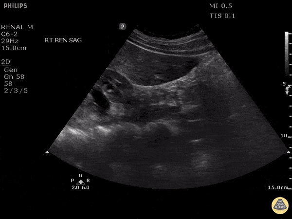 Renal/GU - Two Stones, One Image