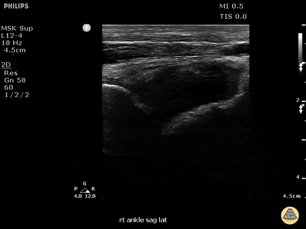 Musculoskeletal - Fusobacterium Septic Joint