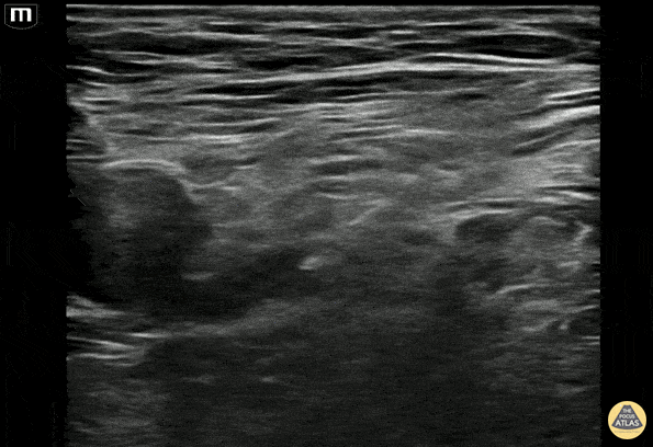 Nerve Block Gallery - Fascia Iliaca Nerve Block Hydrodissection