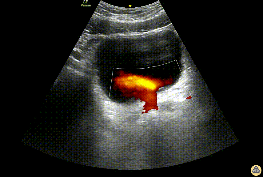 Renal/GU - "Light Saber Sign” Ureteral Jets
