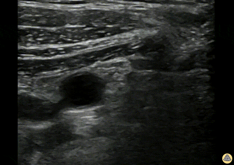 Nerve Block Gallery - Infraclavicular Brachial Plexus Nerve Block