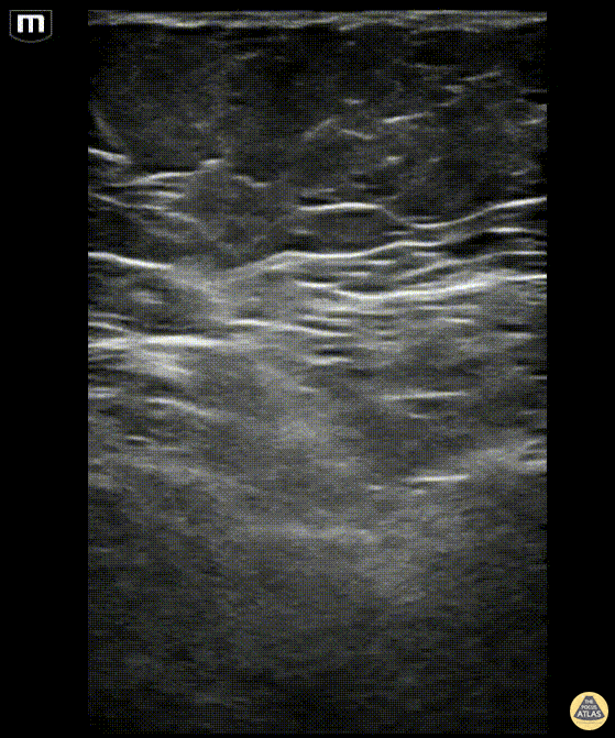 Nerve Block Gallery - Adductor Canal (Saphenous) Nerve Block