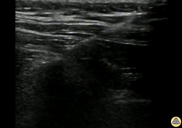 Nerve Block Gallery - Erector Spinae Nerve Block
