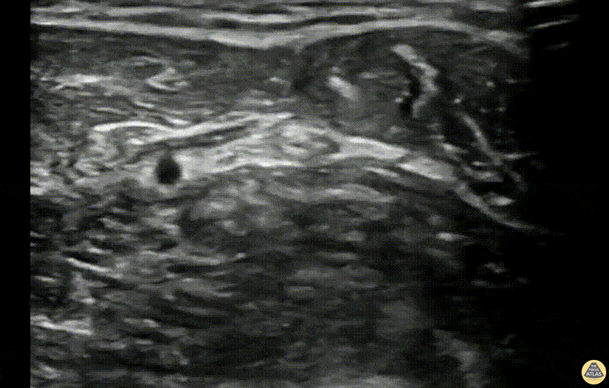 Nerve Block Gallery - Ulnar Nerve Block