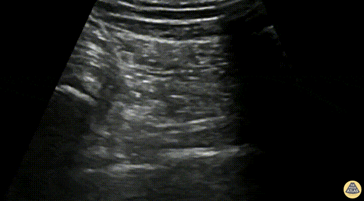 Nerve Block Gallery - Transgluteal (Proximal) Sciatic Nerve Block