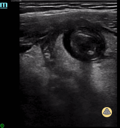 Peds-Gastrointestinal - Appendicolith